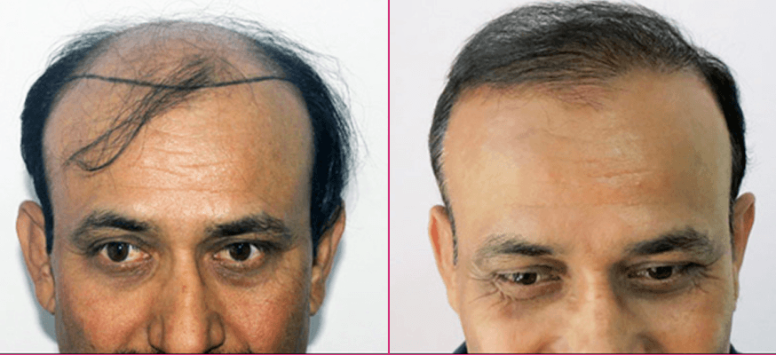 Hair transplant before and after results