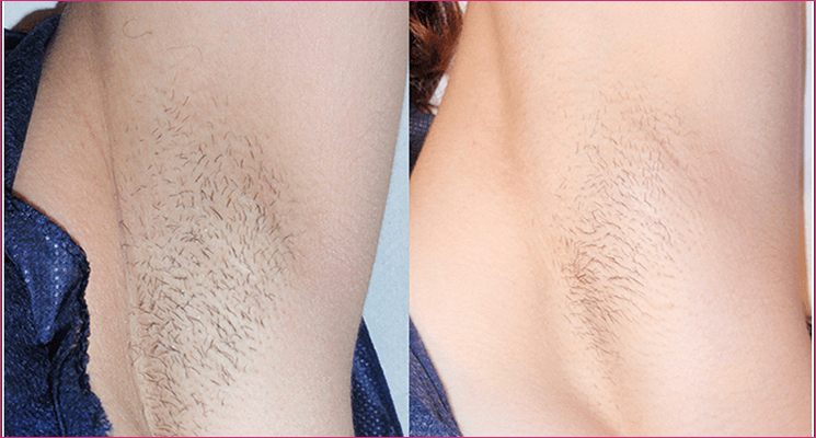 Laser hair removal before and after results