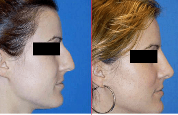 Rhinoplasty before and after results