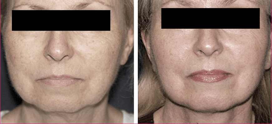 Lip enhancement before and after results
