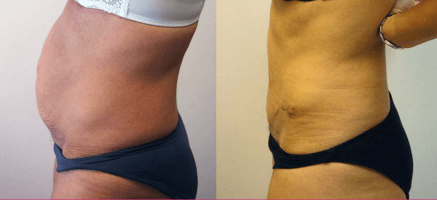 Liposuction before and after results