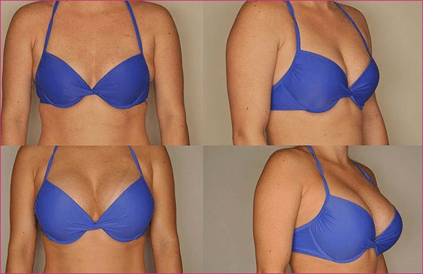 Breast augmentation before and after results