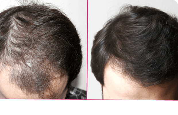 Hair treatment before and after results