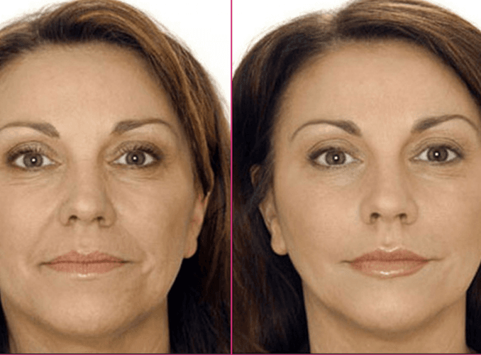 Lip fillers before and after results