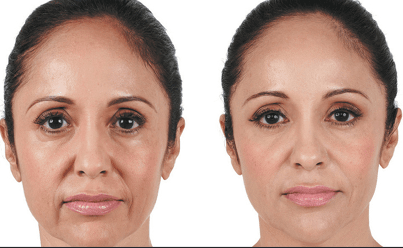 Hyaluronic acid fillers before and after results