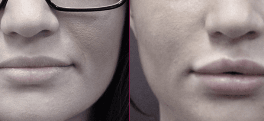 Botox treatment before and after results