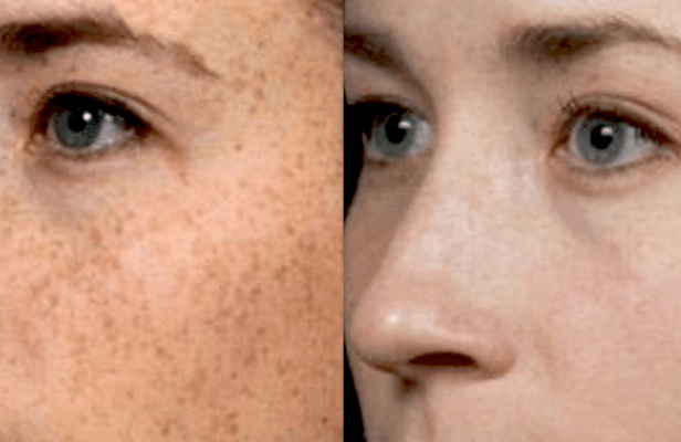 Pigmentation removal before and after results