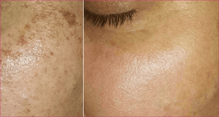 Hyperpigmentation before and after results