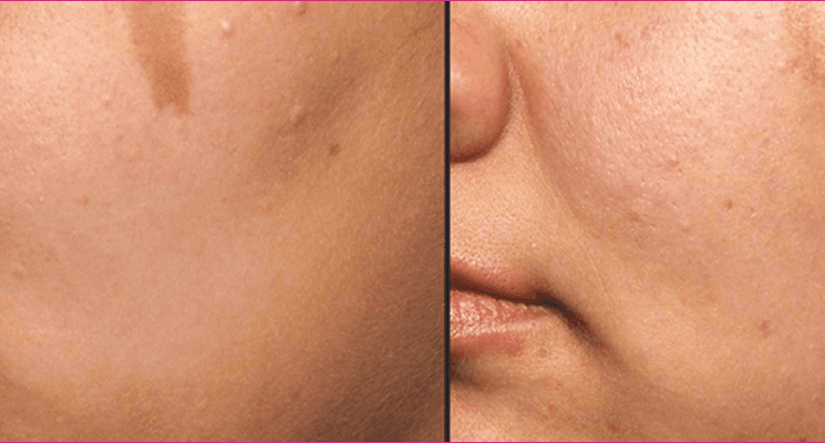 Scar removal before and after results