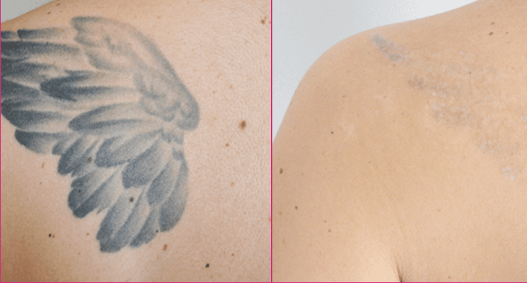Tattoo removal before and after results