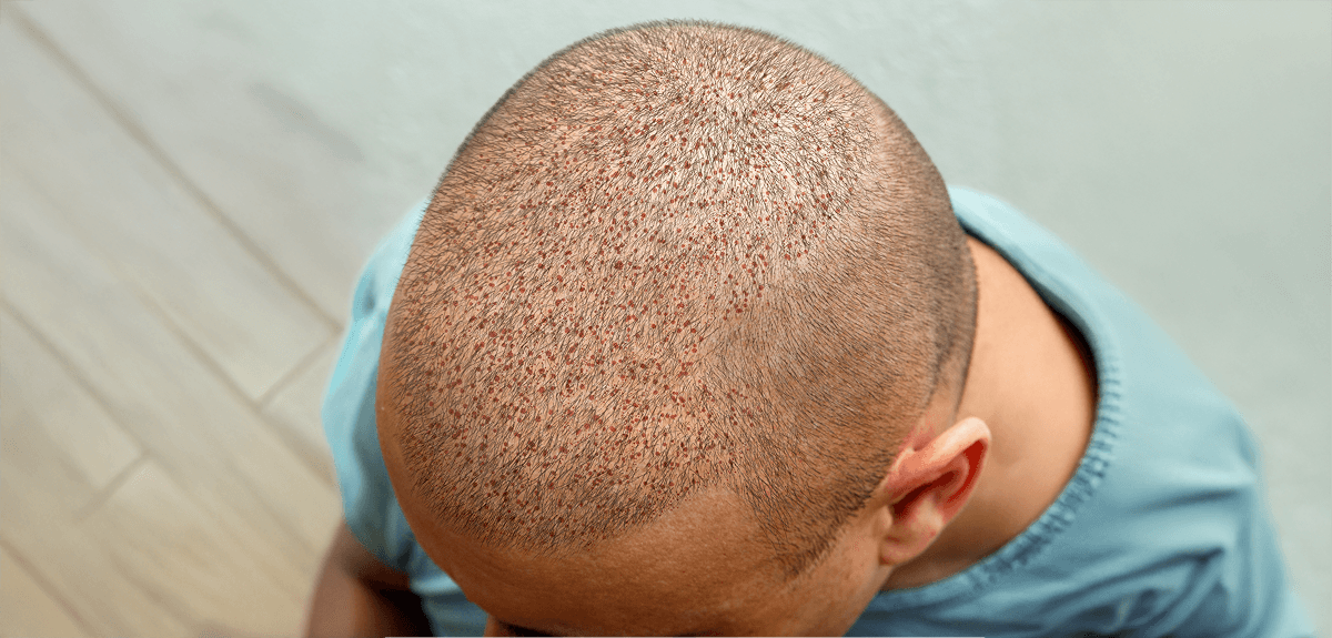 After hair transplant treatment