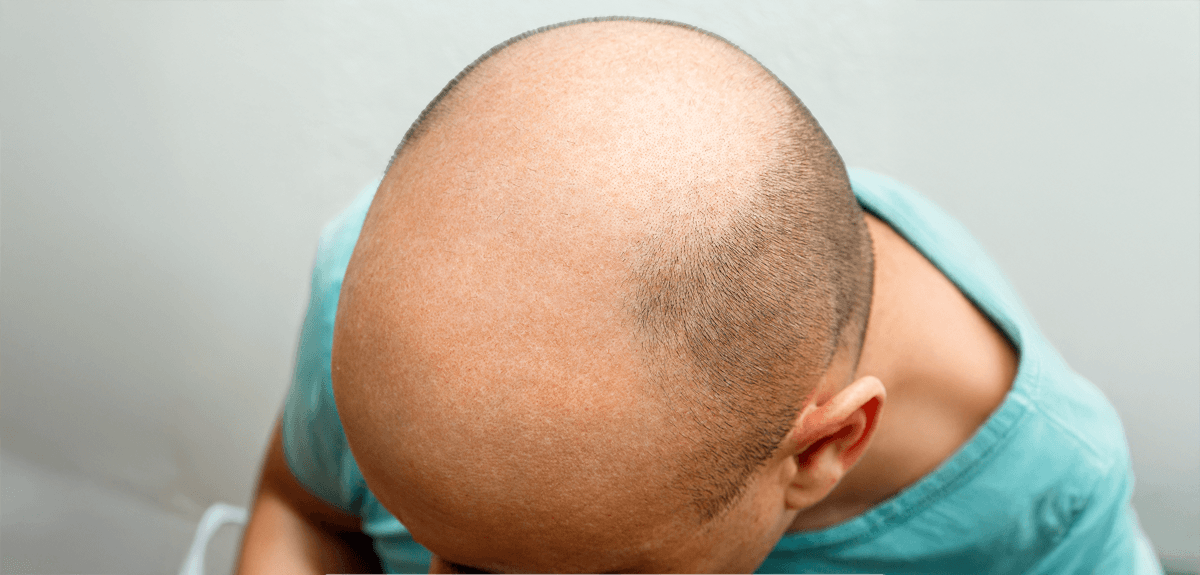 Before hair transplant treatment