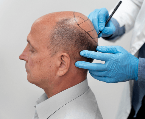 Hair transplant consultation at Looks Clinic